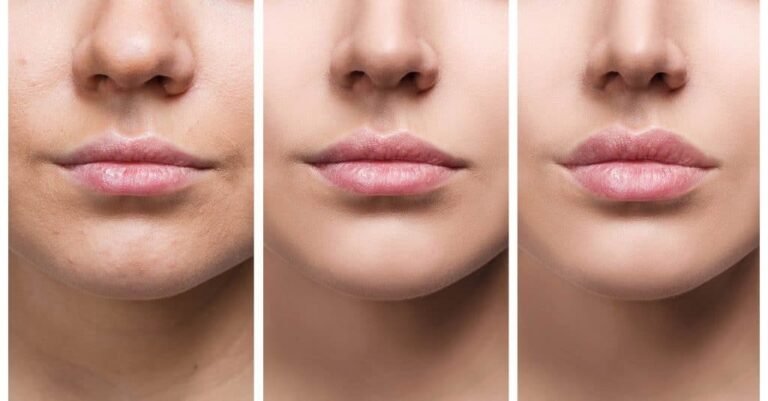 Lip Flip Before and After – Subtle Enhancement with Big Results